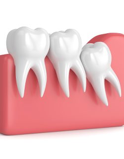 wisdom-teeth